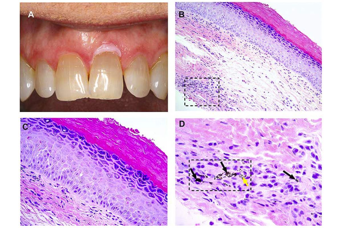 Fig. 1. (A) Clinical image showing a white lesion involving the facial marginal gingiva of tooth #9. (Courtesy of Dr. Reid Lester). (B) Representative photomicrograph showing hyperorthokeratosis and foreign material in the deep lamina propria (square) (hematoxylin and eosin [H&E]; original magnification £ 200). (C) High-power view of the same case shows that the epithelium exhibits dyskeratosis, cellular discohesion, and nuclear pleomorphism limited to the lower one-third of the epithelial thickness—mild dy