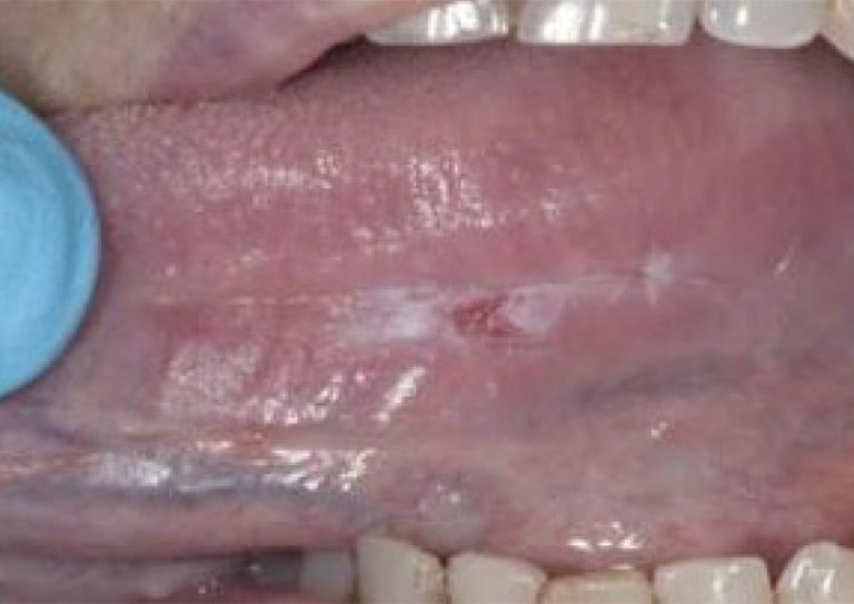 Leukoplakia. Most common precancerous lesion (89%: 618/695)