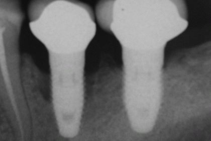 perimplantitis in heavy smoker - source: Wikipedia